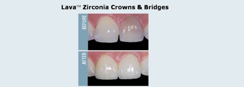 Crown_and_Bridge_10