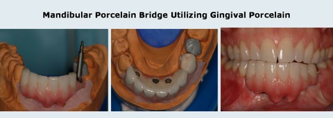 Crown_and_Bridge_5