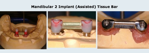 Dentures_2