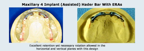 Dentures_3